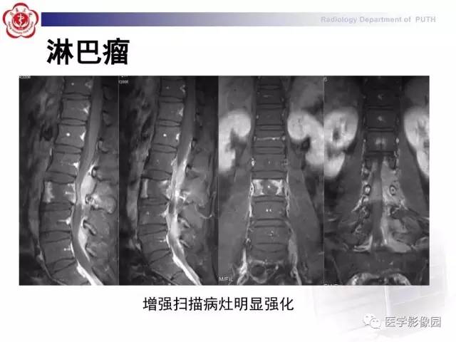 【PPT】脊柱肿瘤影像诊断思路