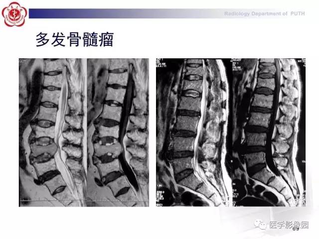 【PPT】脊柱肿瘤影像诊断思路