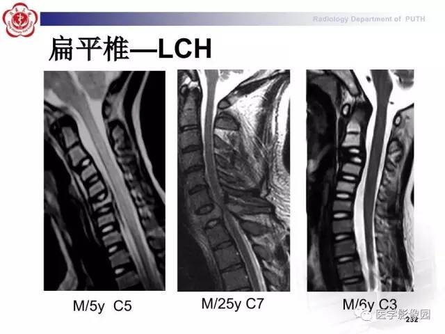 【PPT】脊柱肿瘤影像诊断思路