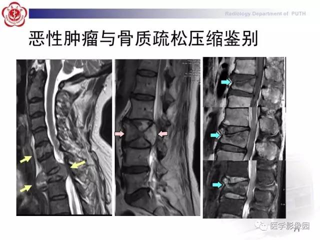 【PPT】脊柱肿瘤影像诊断思路