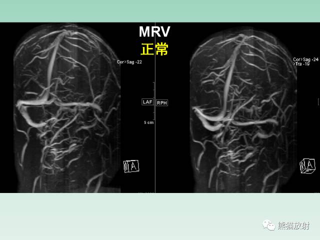 【PPT】可逆性后部脑病综合征