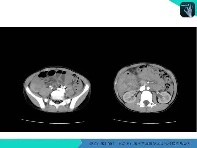 【病例】肝母细胞瘤1例CT影像表现