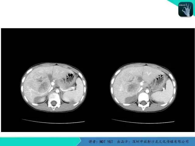 【病例】肝母细胞瘤1例CT影像表现