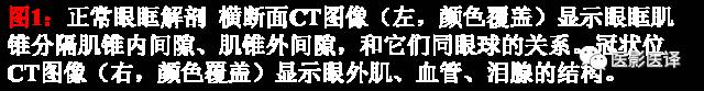 成人眼眶肿瘤:临床、影像、与病理回顾 成人眼眶肿瘤:临床、影像、与病理回顾