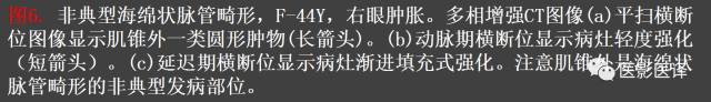 成人眼眶肿瘤:临床、影像、与病理回顾 成人眼眶肿瘤:临床、影像、与病理回顾