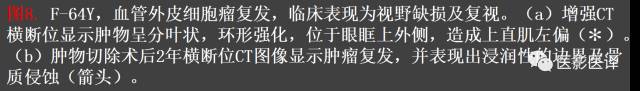 成人眼眶肿瘤:临床、影像、与病理回顾 成人眼眶肿瘤:临床、影像、与病理回顾