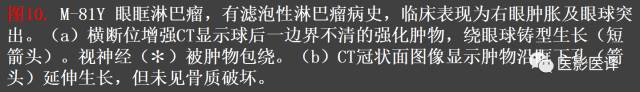 成人眼眶肿瘤:临床、影像、与病理回顾 成人眼眶肿瘤:临床、影像、与病理回顾