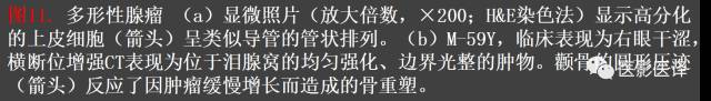 成人眼眶肿瘤:临床、影像、与病理回顾 成人眼眶肿瘤:临床、影像、与病理回顾