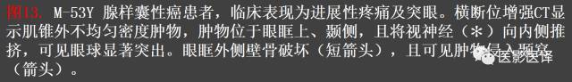 成人眼眶肿瘤:临床、影像、与病理回顾 成人眼眶肿瘤:临床、影像、与病理回顾