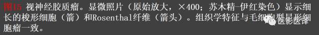 成人眼眶肿瘤:临床、影像、与病理回顾 成人眼眶肿瘤:临床、影像、与病理回顾