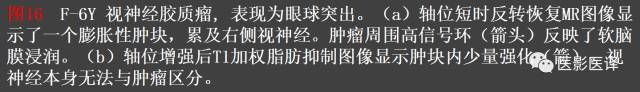 成人眼眶肿瘤:临床、影像、与病理回顾 成人眼眶肿瘤:临床、影像、与病理回顾