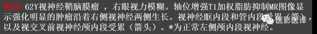 成人眼眶肿瘤:临床、影像、与病理回顾 成人眼眶肿瘤:临床、影像、与病理回顾