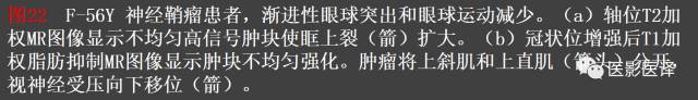 成人眼眶肿瘤:临床、影像、与病理回顾 成人眼眶肿瘤:临床、影像、与病理回顾