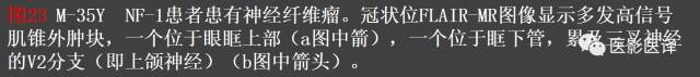 成人眼眶肿瘤:临床、影像、与病理回顾 成人眼眶肿瘤:临床、影像、与病理回顾