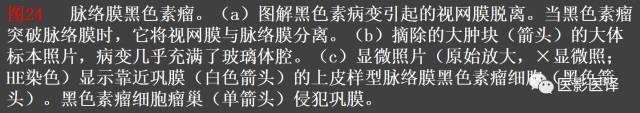 成人眼眶肿瘤:临床、影像、与病理回顾 成人眼眶肿瘤:临床、影像、与病理回顾