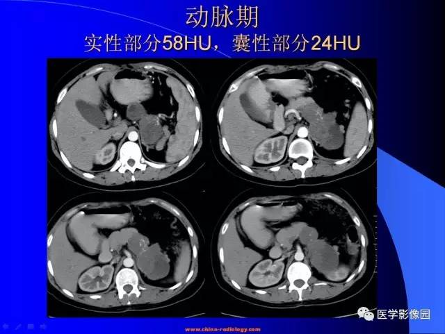 【病例】胰腺实性假乳头状瘤1例CT影像表现 【病例】胰腺实性假乳头状瘤1例CT影像表现