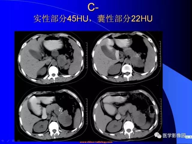 【病例】胰腺实性假乳头状瘤1例CT影像表现