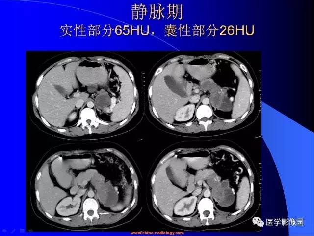 【病例】胰腺实性假乳头状瘤1例CT影像表现 【病例】胰腺实性假乳头状瘤1例CT影像表现