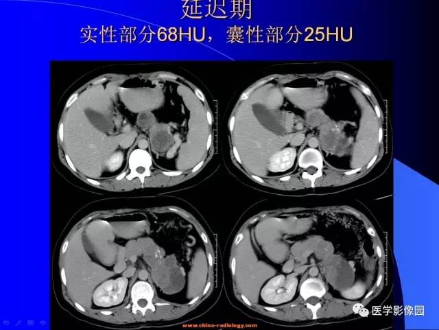 【病例】胰腺实性假乳头状瘤1例CT影像表现 【病例】胰腺实性假乳头状瘤1例CT影像表现