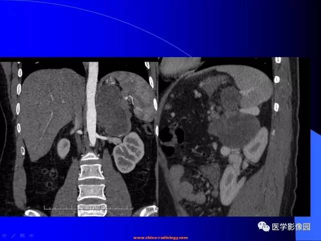【病例】胰腺实性假乳头状瘤1例CT影像表现 【病例】胰腺实性假乳头状瘤1例CT影像表现