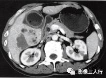 【病例】肝外生性海绵状血管瘤1例CT影像表现 【病例】肝外生性海绵状血管瘤1例CT影像表现