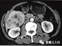 【病例】肝外生性海绵状血管瘤1例CT影像表现 【病例】肝外生性海绵状血管瘤1例CT影像表现