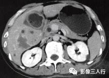 【病例】肝外生性海绵状血管瘤1例CT影像表现 【病例】肝外生性海绵状血管瘤1例CT影像表现