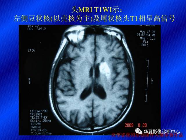 【病例】非酮症高血糖合并偏侧舞蹈症1例CT影像表现