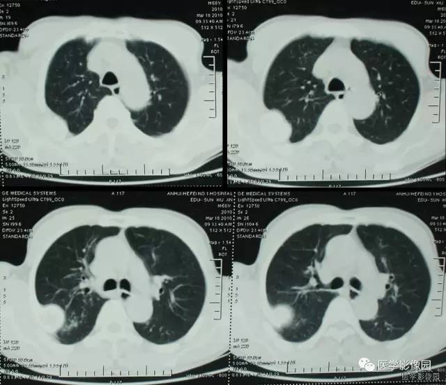 【病例】肋骨海绵状血管瘤1例CT