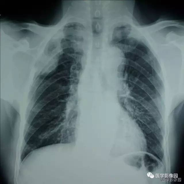 【病例】肋骨海绵状血管瘤1例CT