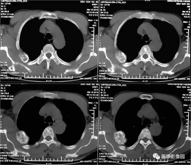 【病例】肋骨海绵状血管瘤1例CT