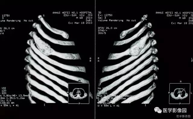 【病例】肋骨海绵状血管瘤1例CT