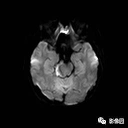 【病例】桥小脑脚区表皮样囊肿1例MR影像表现 【病例】桥小脑脚区表皮样囊肿1例MR影像表现