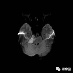 【病例】桥小脑脚区表皮样囊肿1例MR影像表现 【病例】桥小脑脚区表皮样囊肿1例MR影像表现