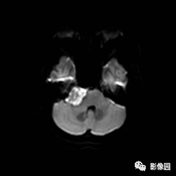 【病例】桥小脑脚区表皮样囊肿1例MR影像表现 【病例】桥小脑脚区表皮样囊肿1例MR影像表现