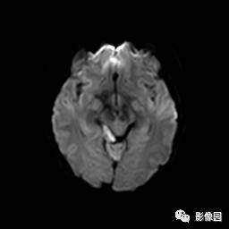 【病例】桥小脑脚区表皮样囊肿1例MR影像表现 【病例】桥小脑脚区表皮样囊肿1例MR影像表现