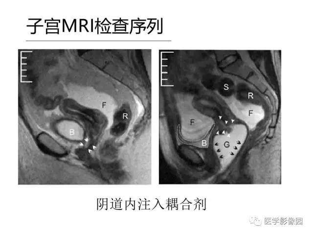 【PPT】女性盆腔肿瘤的MR成像技术与诊断思路
