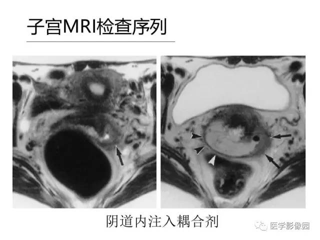 【PPT】女性盆腔肿瘤的MR成像技术与诊断思路
