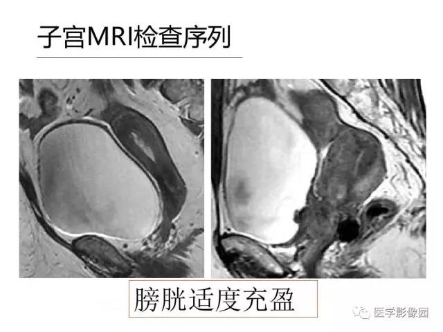 【PPT】女性盆腔肿瘤的MR成像技术与诊断思路