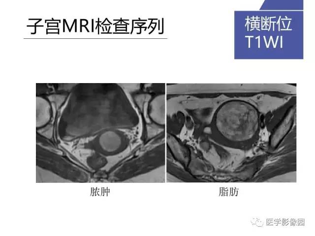 【PPT】女性盆腔肿瘤的MR成像技术与诊断思路