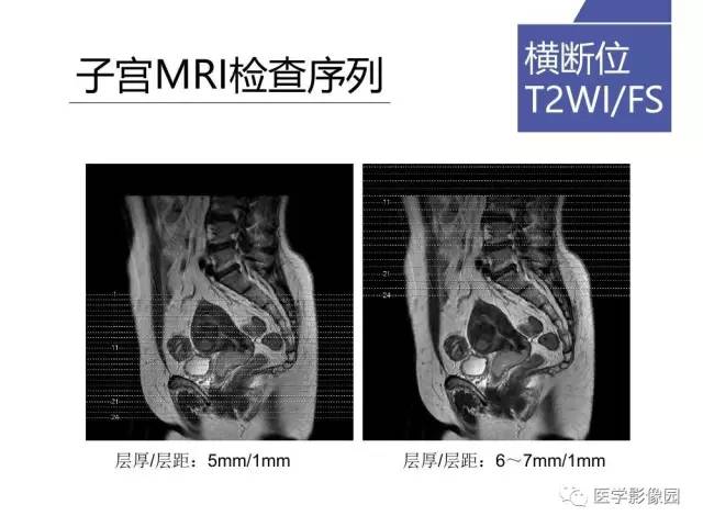 【PPT】女性盆腔肿瘤的MR成像技术与诊断思路