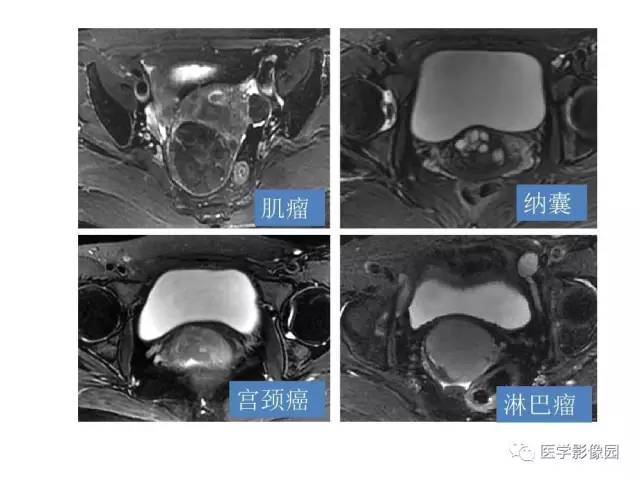 【PPT】女性盆腔肿瘤的MR成像技术与诊断思路