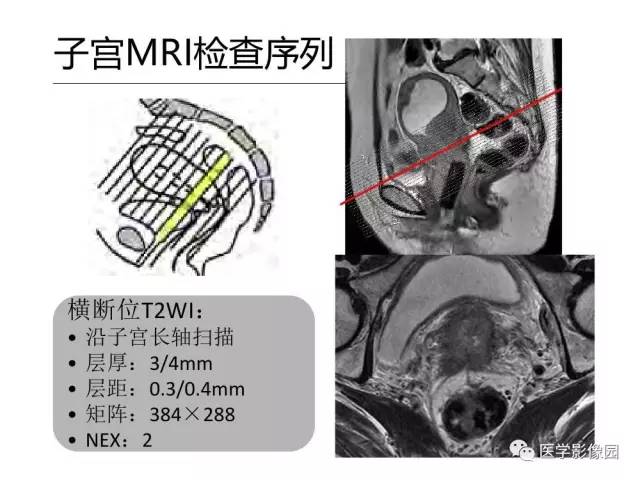 【PPT】女性盆腔肿瘤的MR成像技术与诊断思路