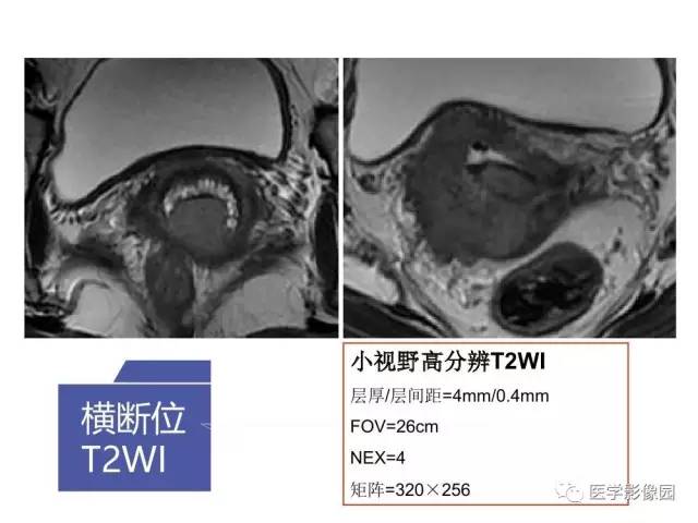 【PPT】女性盆腔肿瘤的MR成像技术与诊断思路