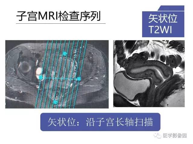 【PPT】女性盆腔肿瘤的MR成像技术与诊断思路