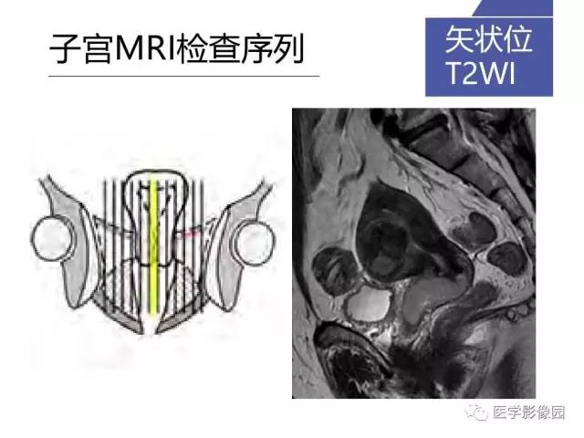 【PPT】女性盆腔肿瘤的MR成像技术与诊断思路