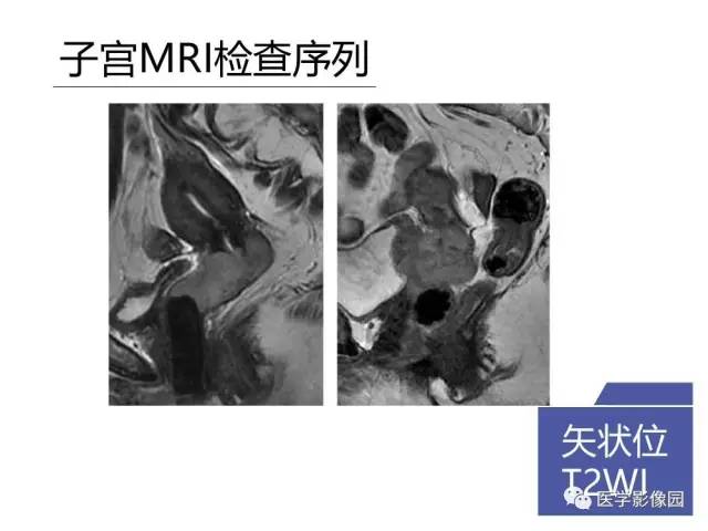 【PPT】女性盆腔肿瘤的MR成像技术与诊断思路