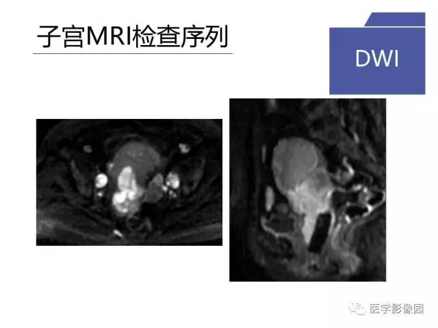 【PPT】女性盆腔肿瘤的MR成像技术与诊断思路
