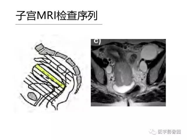 【PPT】女性盆腔肿瘤的MR成像技术与诊断思路