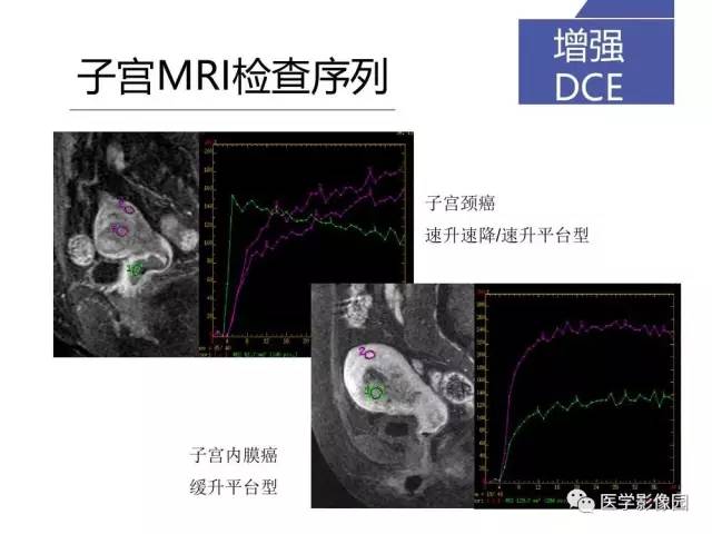 【PPT】女性盆腔肿瘤的MR成像技术与诊断思路